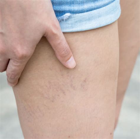 Spider Veins Simply Veins