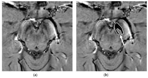 Brain Sciences Free Full Text Imaging Of Substantia Nigra In Parkinsons Disease A