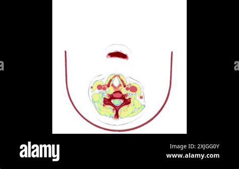 Coloured Computed Tomography Ct Scan Moving From The Base To The Top