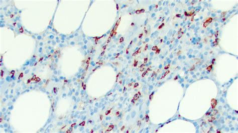 Pathology Outlines Mast Cells