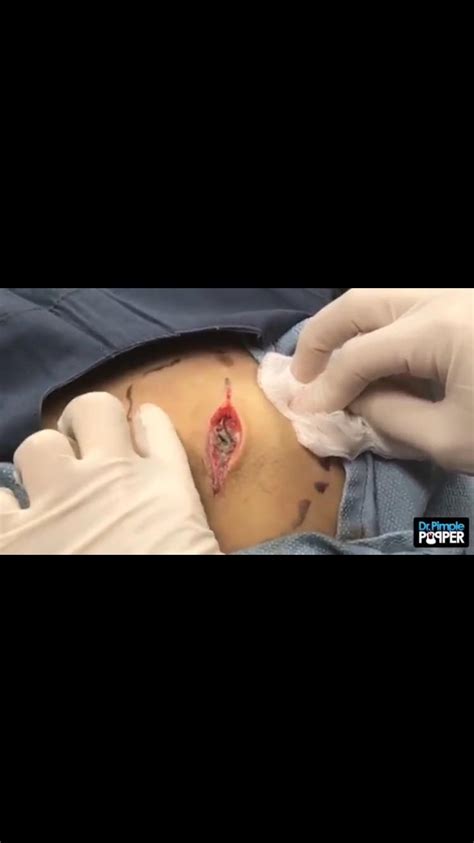 This 50 Year Old Cyst Popped By A Dermatologist Who Lets A Cysts Grow For 50 Years R