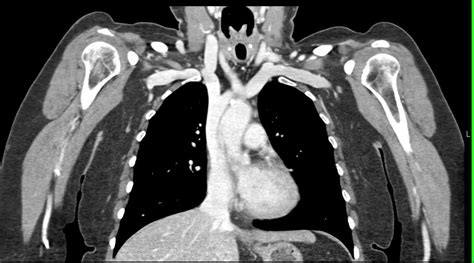 Occluded Proximal Lef Tsubclavian Artery With Bypass Graft From Left Carotid To Left Subclavian