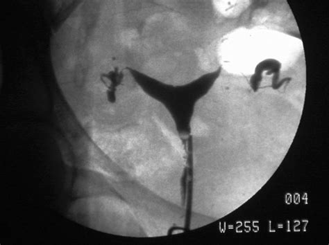 Bicornuate or septate uterus? (part 1) - Alabama Fertility