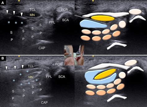 Frontiers Ultrasound Guided Triamcinolone Acetonide Hydrodissection For Carpal Tunnel Syndrome