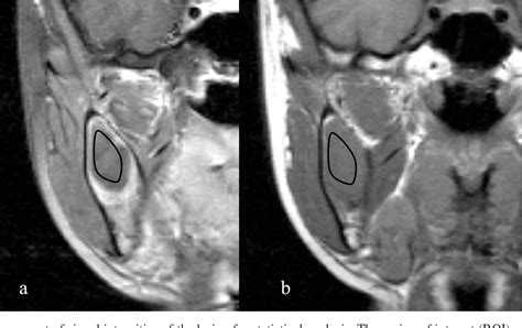 Figure 1 From Usefulness Of MRI And Dynamic Contrast Enhanced MRI For