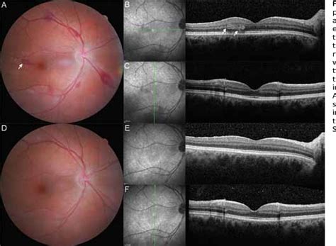 Figure 1 from Sudden Occurrence of Roth Spots and Retinal Hemorrhages ...