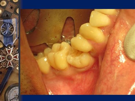 ankylosis of teeth