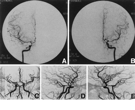 A B Right A And Left B Internal Carotid Angiograms 6 Months After