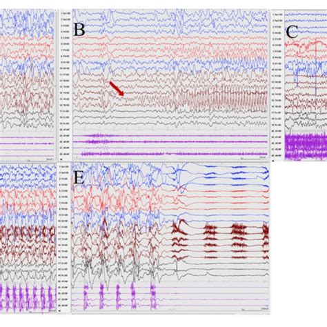 The Ictal Eeg Of Patient A E Hz Generalized Spike And Waves