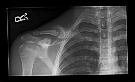 Ortho Dx Clavicle Discomfort Following A Fall Clinical Advisor