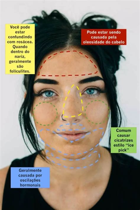 Mapa Das Espinhas O Que O Local Da Sua Acne Pode Dizer Sobre Ela