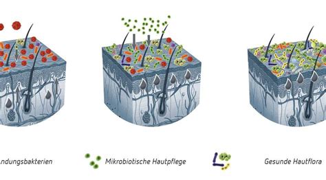 IFEMEDI Das Entgleiste Hautmikrobiom Bei Neurodermitis Experten