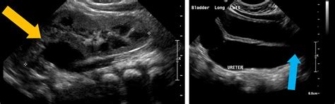 (Left) ultrasonographic images of a duplicated collecting system with... | Download Scientific ...