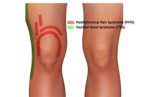 Runners Knee Causes Treatment Symptoms And Prevention