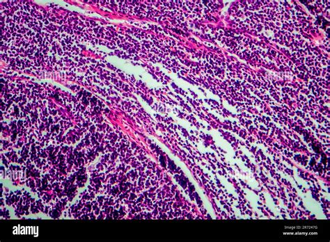 Hodgkins Lymphoma Light Micrograph Photo Under Microscope Stock