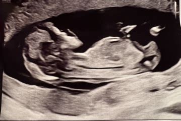 12 Week Scan Gender Predictions Mumsnet