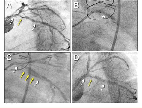 Figure From Peri Stent Abluminal Hematoma And Pin Hole Balloon