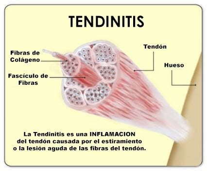 Tendinopatias Tendinitis Tendinosis Centro De Acupuntura En The Best