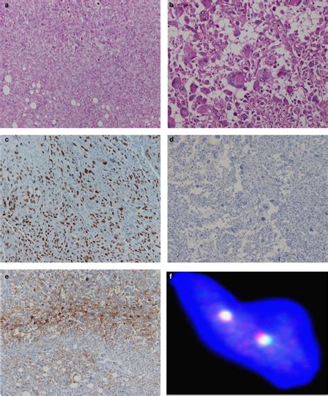 Ywhae Rearrangement Identified By Fish And Rt Pcr In Endometrial