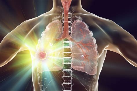 Afatinib Outperforms First-Generation EGFR-TKIs in NSCLC With Uncommon ...