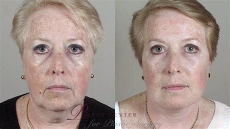 Facelift Before And After Pictures Case 30 Paramus New Jersey Parker Center For Plastic Surgery