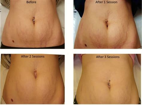 Laser Stretch Mark Removal Doctors Review Before After