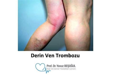 Derin Ven Trombozu Nedir Prof Dr Yavuz Beşoğul