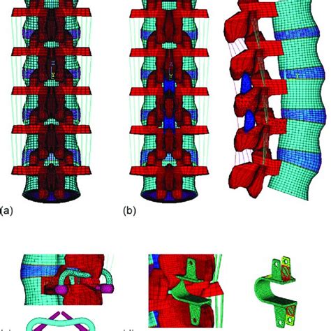 Finite Element Model Of The A Intact Lumbar Spine Implanted With Two