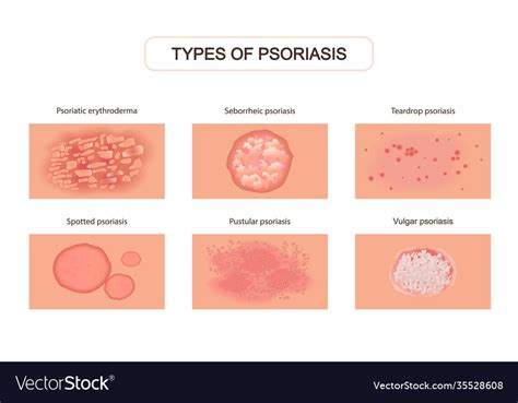 Allergic Eczema Types Rashes Dermatology Infect By Microvector