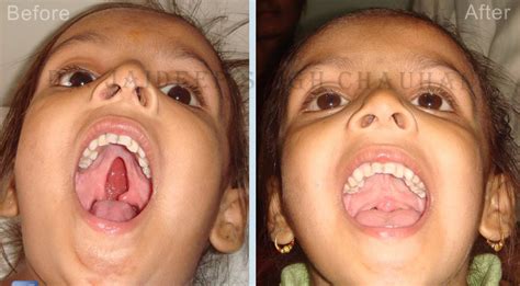 Dr Jaideep Chauhan Maxillo Facialcleft Lipcleft Palate Surgeon