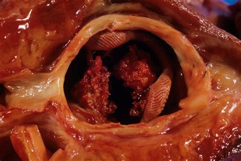 Infective Endocarditis Mitral Valve