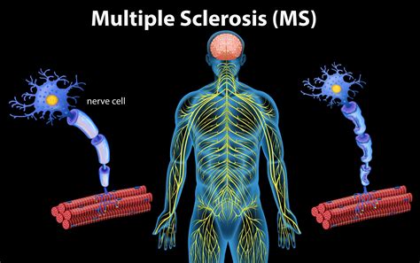 Ms Related Symptoms And Manual Osteopathy Best Osteopathy