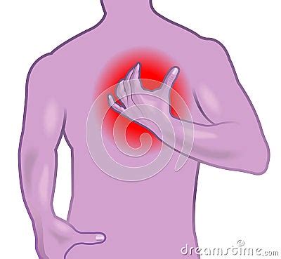 Infarct Medical Illustration CartoonDealer 119234818