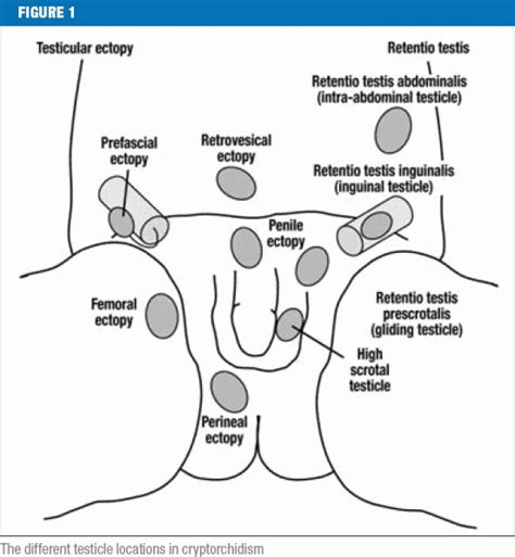 Undescended Testis Cryptorchidism