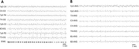 Representative Eeg Epochs Showing Left Sided Lateralized Periodic