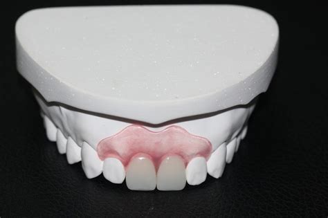 Valplast Partial Flexible Partials Full Implant Hybrid Denture