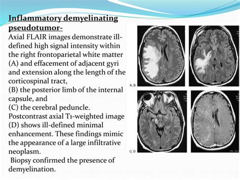 Radiology Of Demyelinating Diseases Ppt