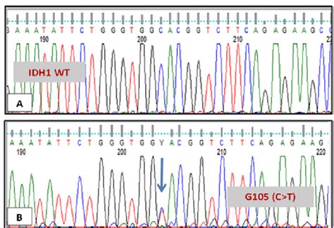 Sequencing result of IDH1 in two different patients. (A) Patient with ...