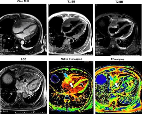 Three Tesla Magnetic Resonance Imaging On Cine Mri A Large Mass Is