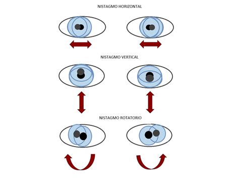 El Nistagmo Neuroftalmolog A Institut Catal De Retina