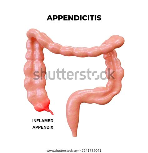 Appendicitis Consists Inflammation Infection Appendix Small Stock ...