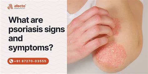 What are psoriasis signs and symptoms?