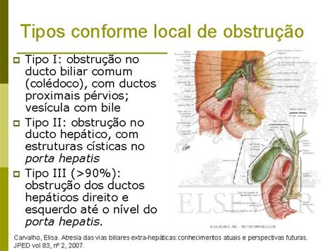 Atresia De Vias Biliares Extrahepticas Residente Larissa Caetano