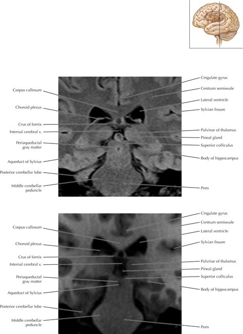 Thalamus And Basal Ganglia Radiology Key