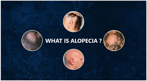 Alopecia Areata Symptoms Causes Treatment Hair Loss Types