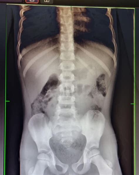 Fecal impaction progress scan : r/medical