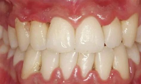 Gingivitis Y Periodontitis Durante El Embarazo Ferrus Bratos