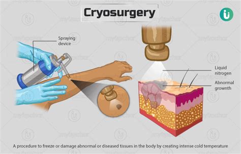 Cryosurgery Procedure Purpose Results Cost Price Indications