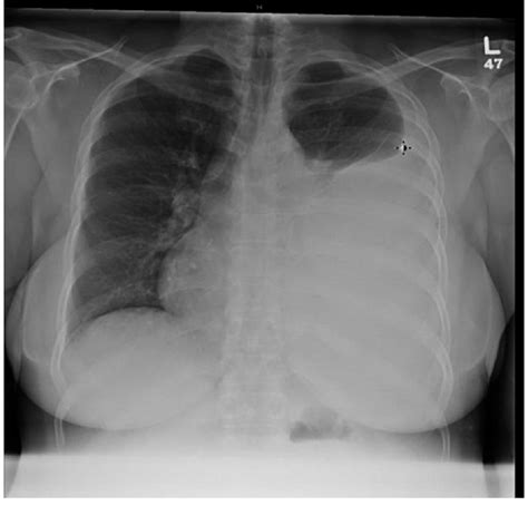 Pleural Effusion On X Ray