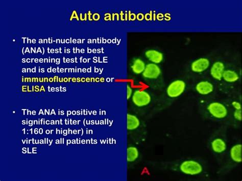 Anti Nuclear Antibody Positive Result